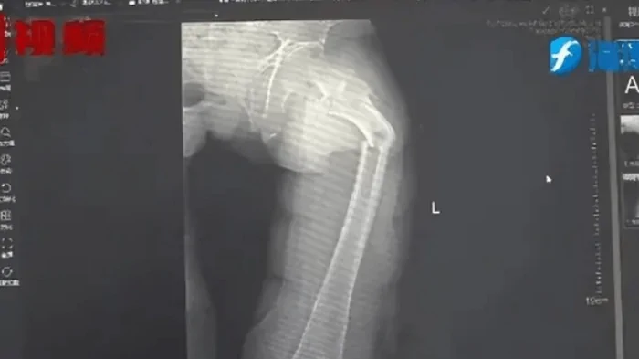 35-летний мужчина сломал самую крепкую кость в теле во время кашля: известна причина